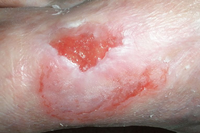 ..herber Rückschlag, zu viel Streß?