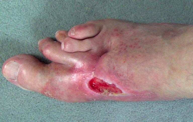 Fusswunde Mitte 2008